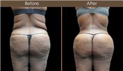 Gluteal Fat Grafting Results